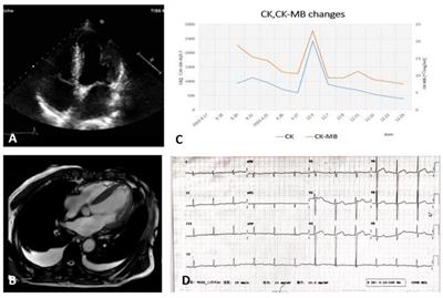 Case Report: Systemic Amyloidosis Involving the Heart and Skeletal Muscle